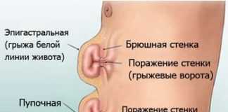 Грыжа живота: симптомы и оперативное лечение